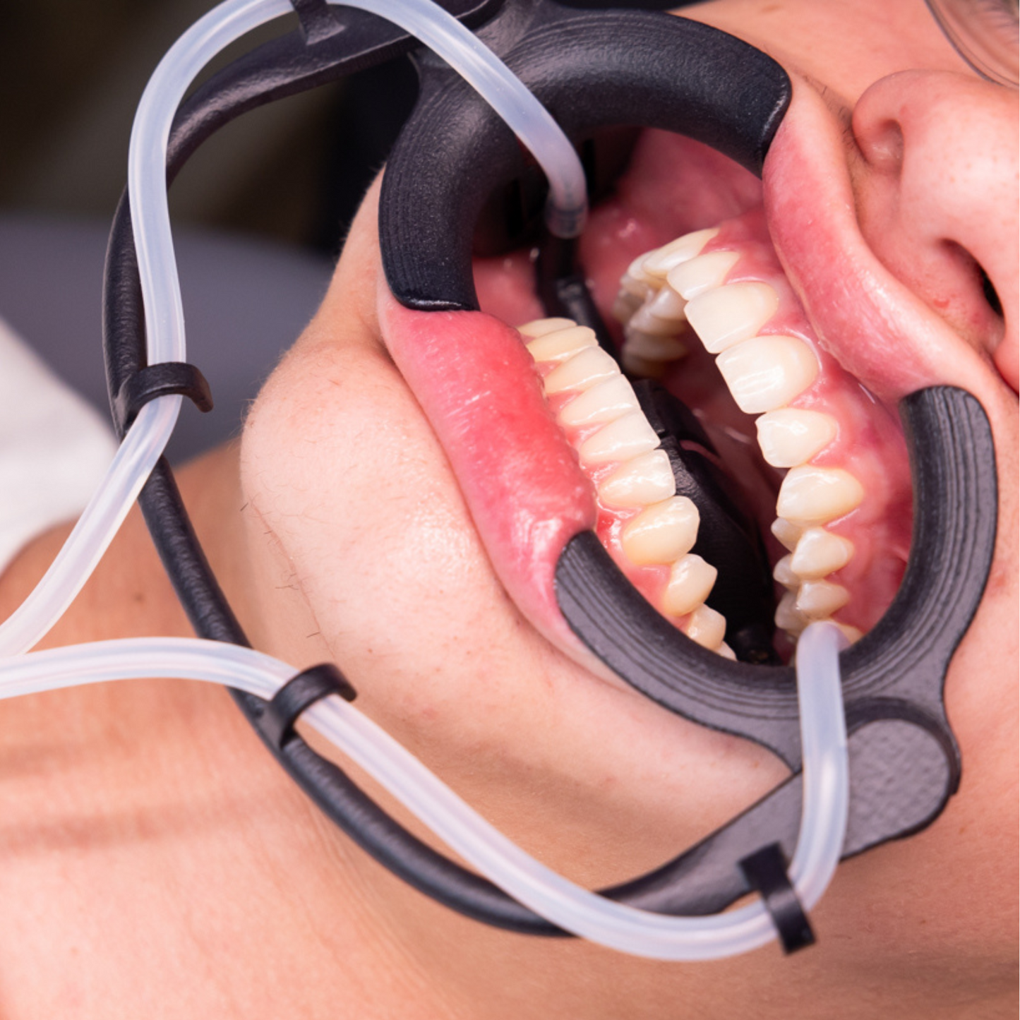 ISORETRACT – Orthodontic Mouth Retractor for Comfort & Isolation